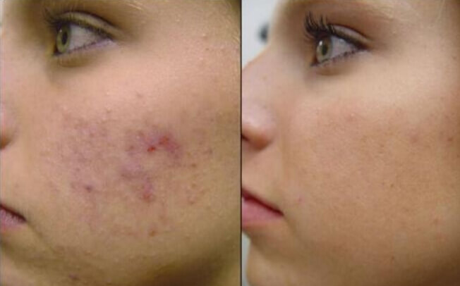 antes y después de cicatrices de acné