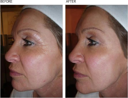 before and after wrinkle serum