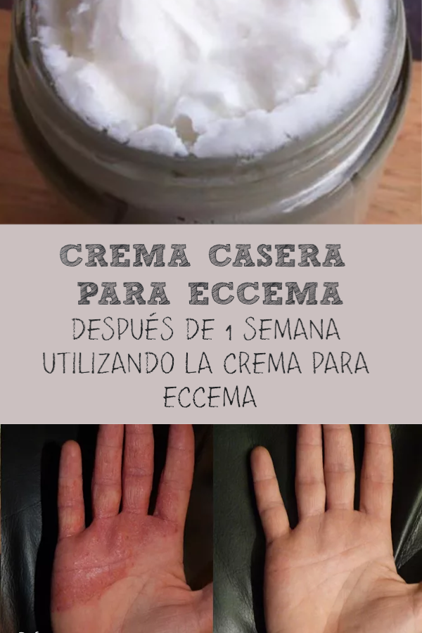 Crema DIY para Eczema