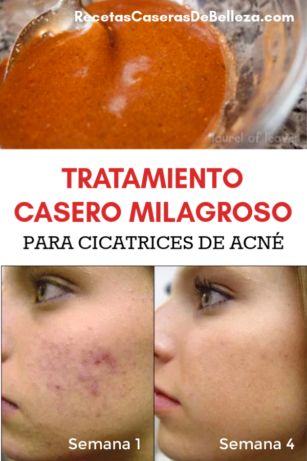 tratamiento casero para las cicatrices de acné